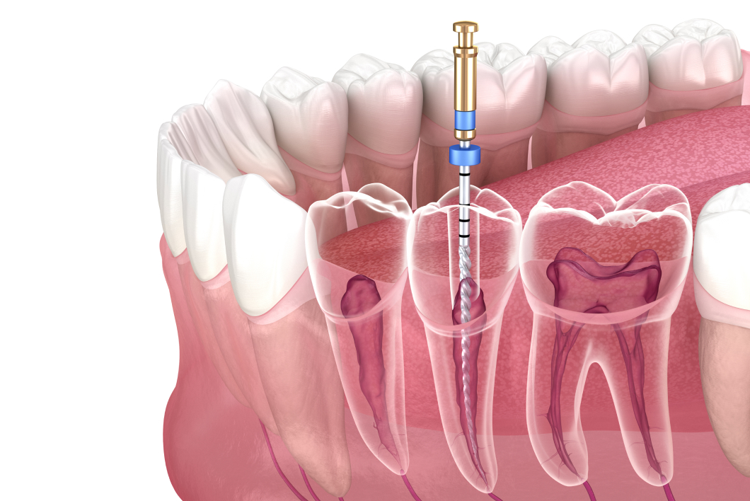 根管治療（歯内療法）
